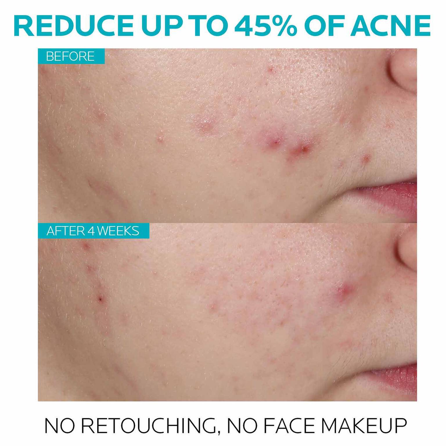 effaclar-salicylic-acid-acne-treatment-serum-e8 7_EffaclarSerum_After-45-days.jpg