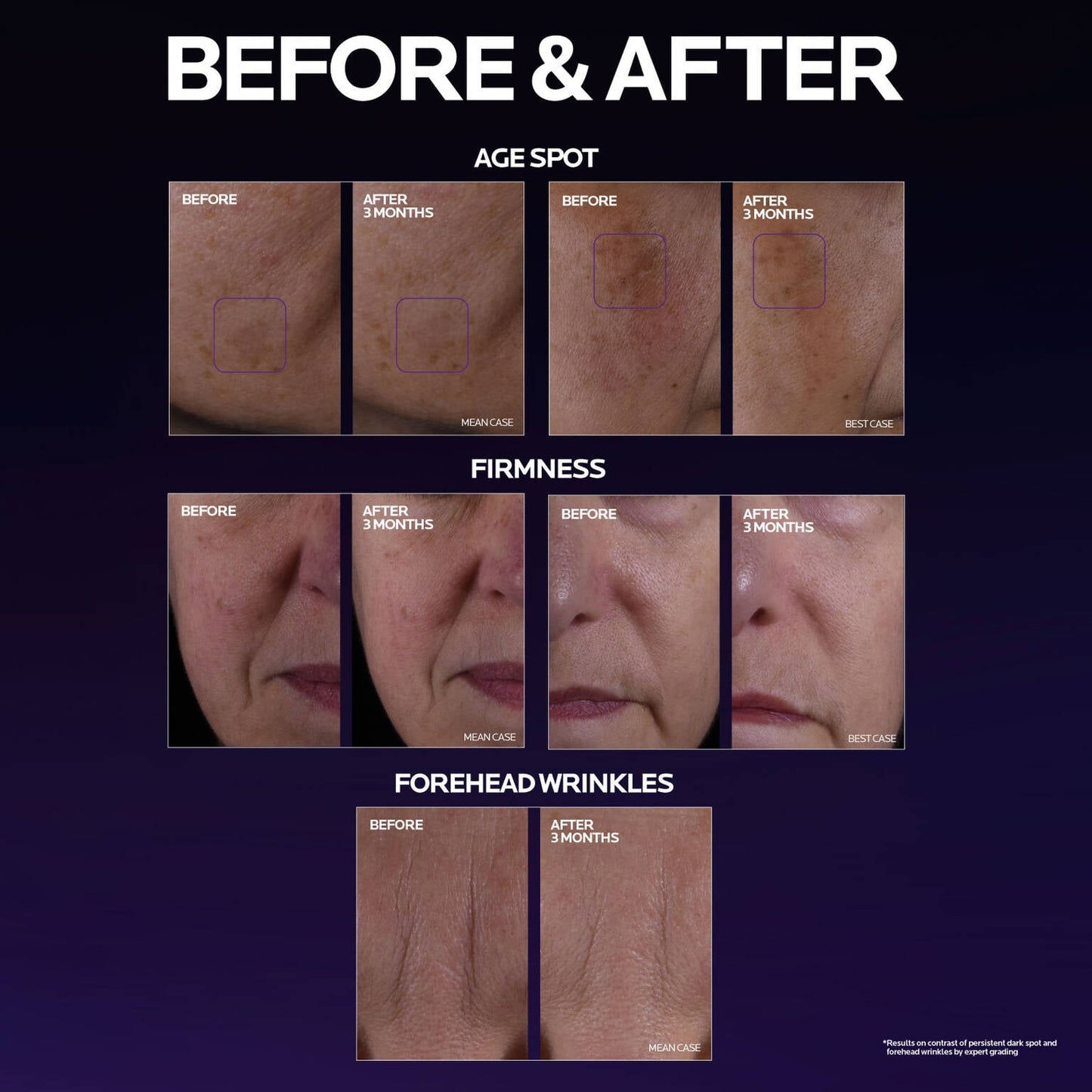 mela-b3-double-dose-discoloration-treatment-with-melasyltm-q4 MelaB3_DD_BTF_BeforeAfter_1500x1500_5.jpg