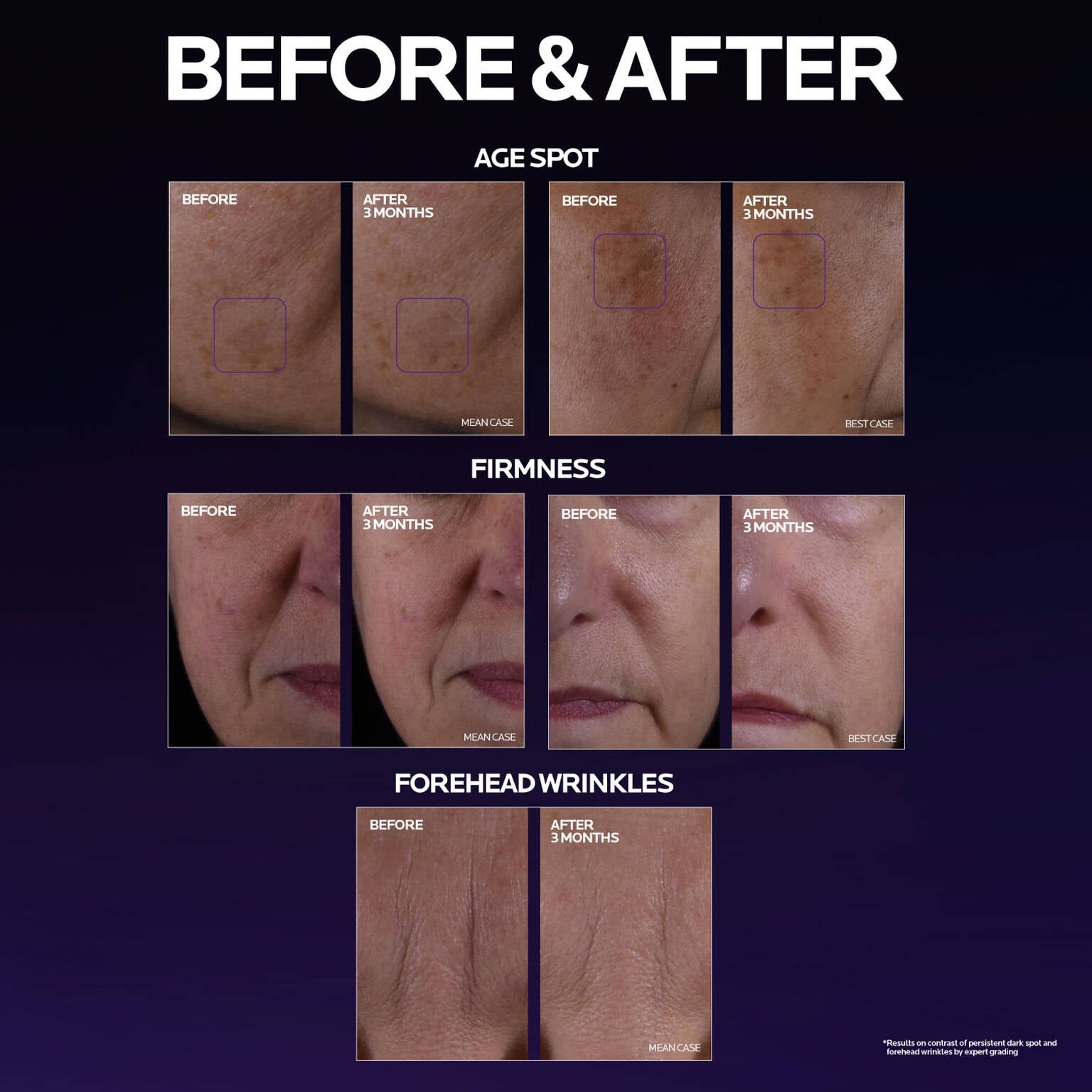 mela-b3-double-dose-discoloration-treatment-with-melasyltm-q4 MelaB3_DD_BTF_BeforeAfter_1500x1500_5.jpg